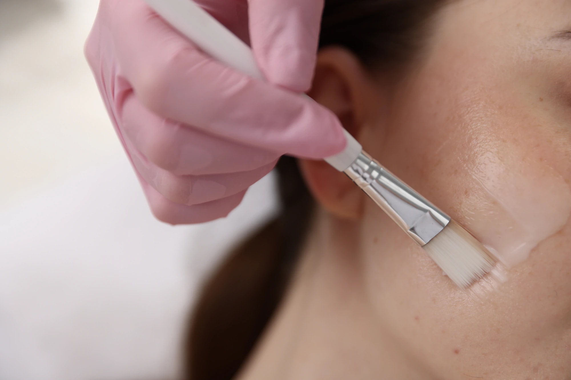 A gloved provider applying a chemical peel solution to a client's cheek with a brush