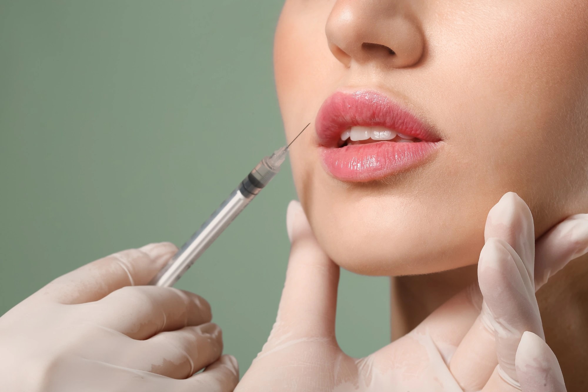 A gloved provider holding a syringe near a woman's lips before a lip filler injection, the start of the lip filler recovery timeline